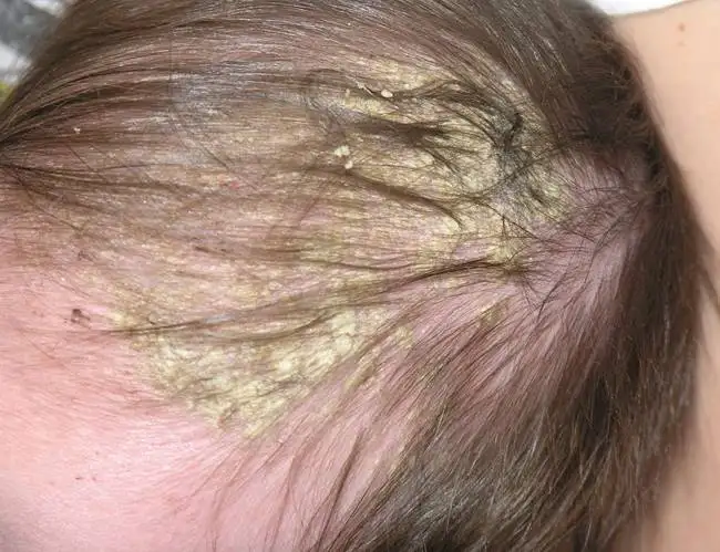 Dermatitis Seborreica del lactante